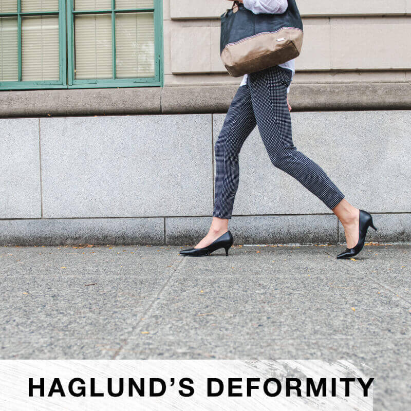 Haglunds Deformity